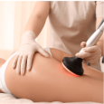 Masaje Anticelulítico – Reduce la Apariencia de la Celulitis Mujer recibiendo terapia de radiofrecuencia en sus piernas.
